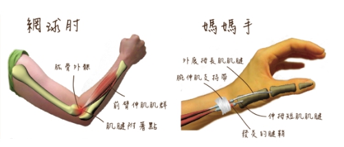 媽媽手網球肘 媽媽手網球肘