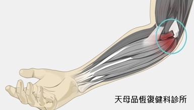 高爾夫球肘 高爾夫球肘