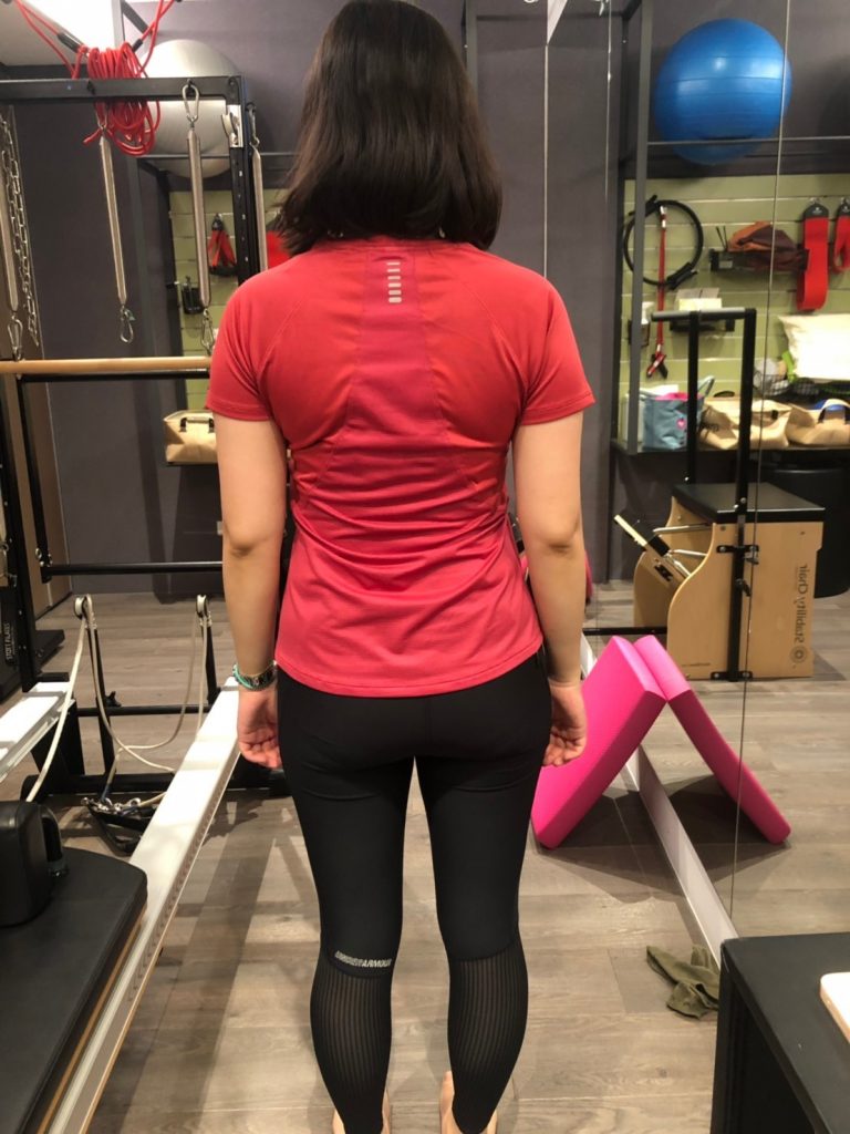 個案經驗分享─脊椎側彎 個案經驗分享─脊椎側彎
