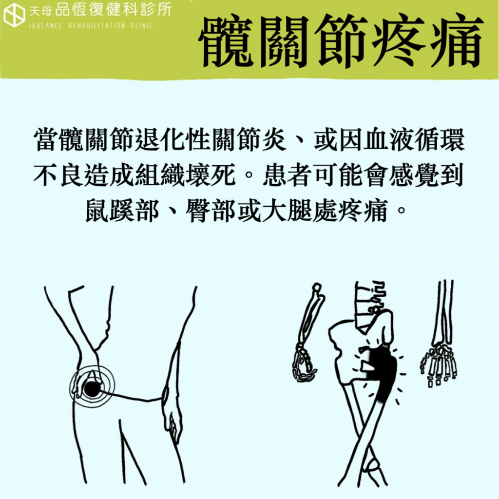 髖關節疼痛 髖關節疼痛