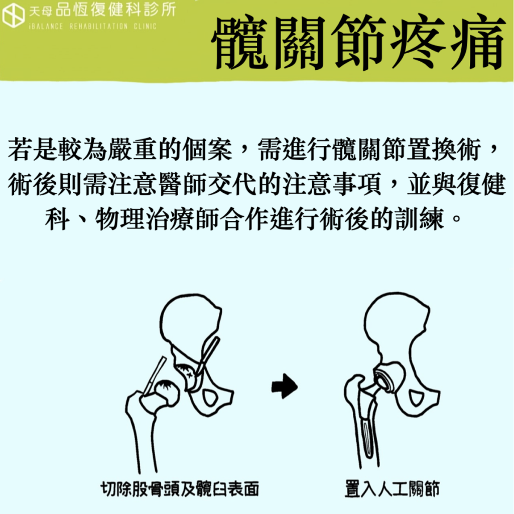 髖關節疼痛 髖關節疼痛