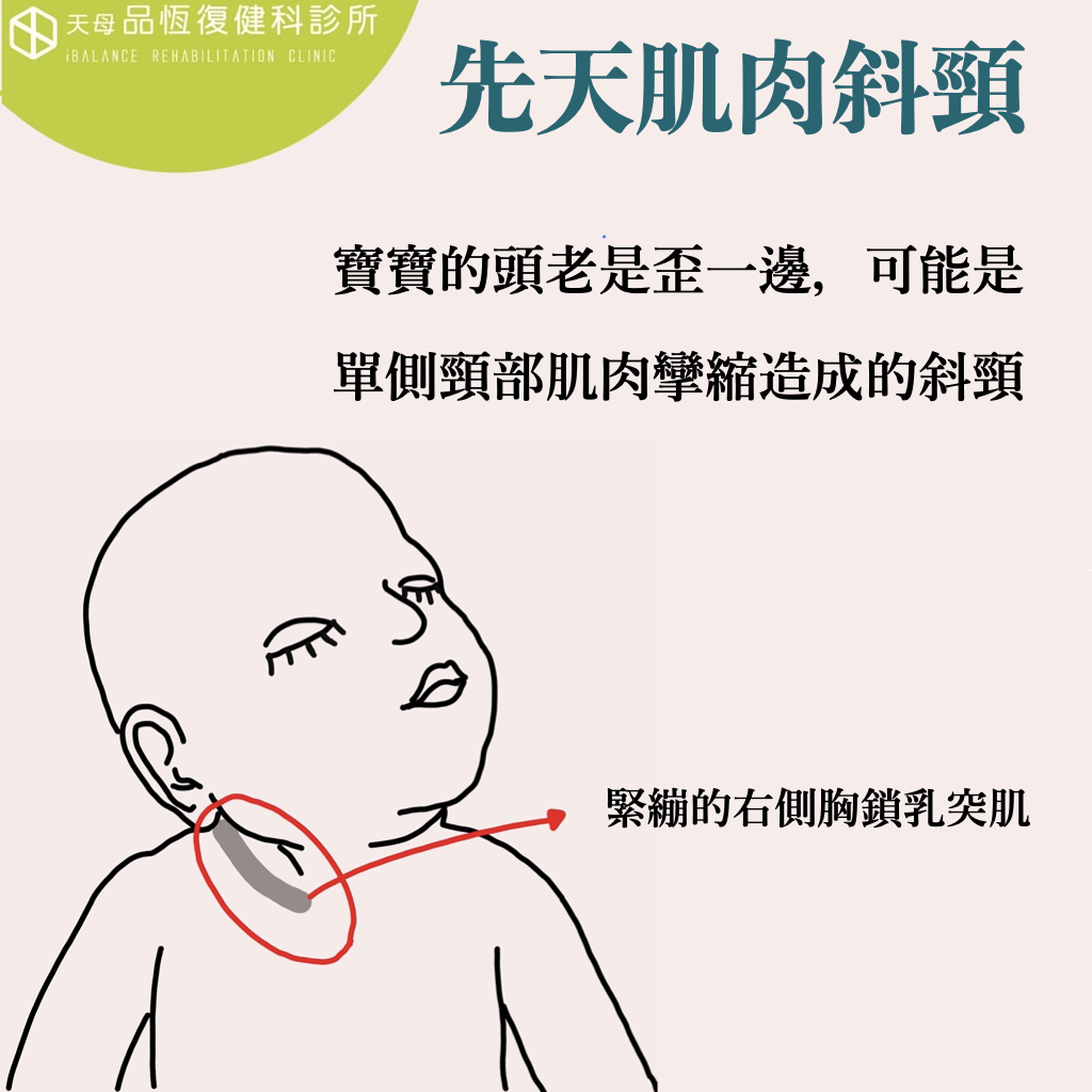 寶寶頭歪一邊 : 先天肌肉斜頸 寶寶頭歪一邊 : 先天肌肉斜頸