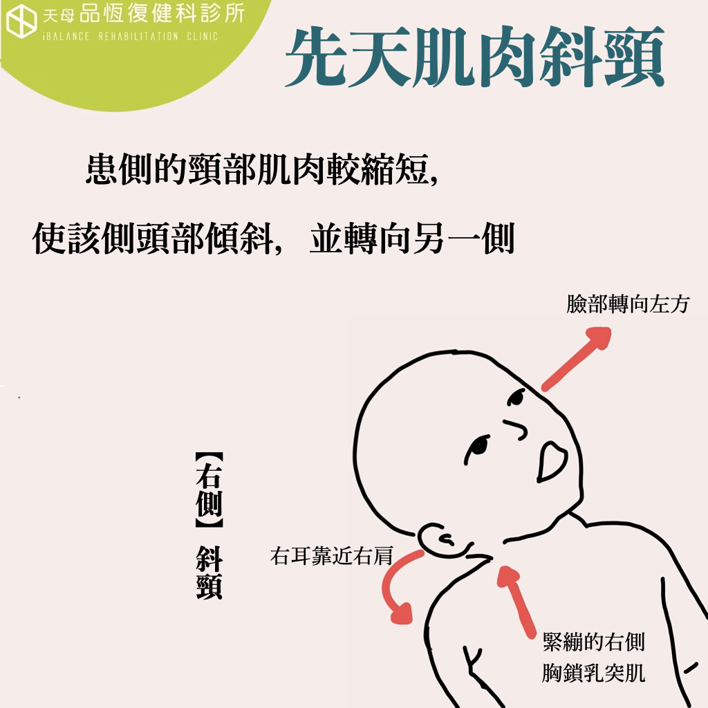 寶寶頭歪一邊 : 先天肌肉斜頸 寶寶頭歪一邊 : 先天肌肉斜頸