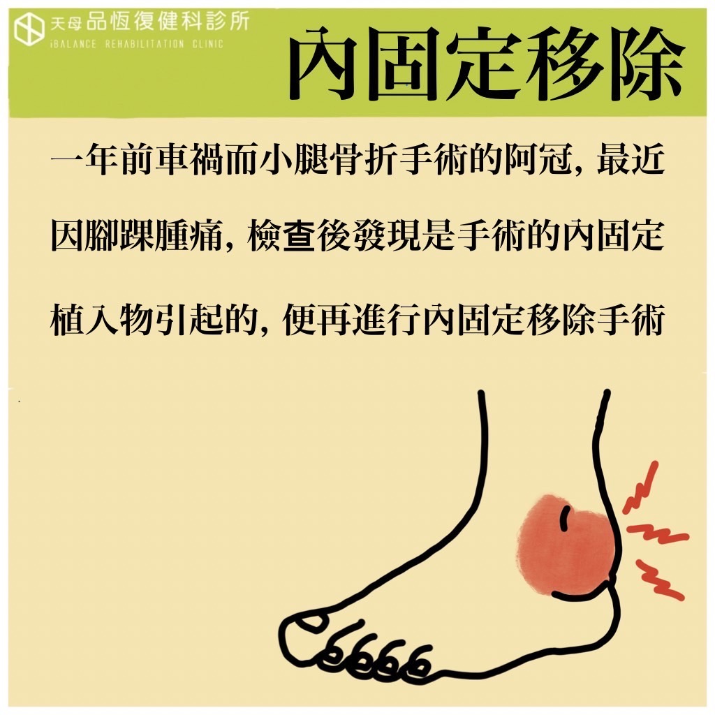 骨折內固定器移除之後, 還需要復健嗎? 骨折內固定器移除之後, 還需要復健嗎?