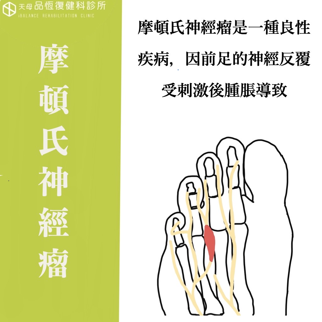 Morton's neuroma 摩頓氏神經瘤 Morton's neuroma 摩頓氏神經瘤