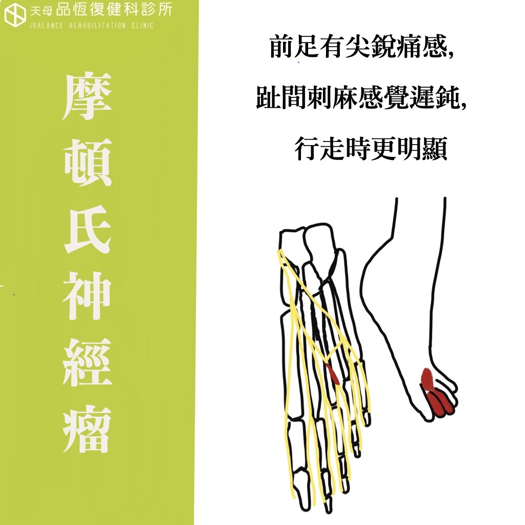 Morton's neuroma 摩頓氏神經瘤 Morton's neuroma 摩頓氏神經瘤