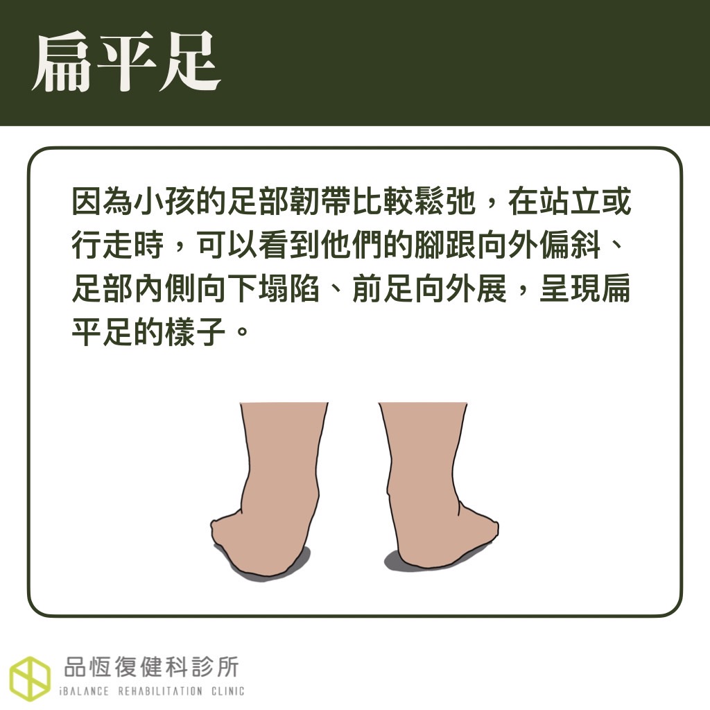 扁平足 扁平足