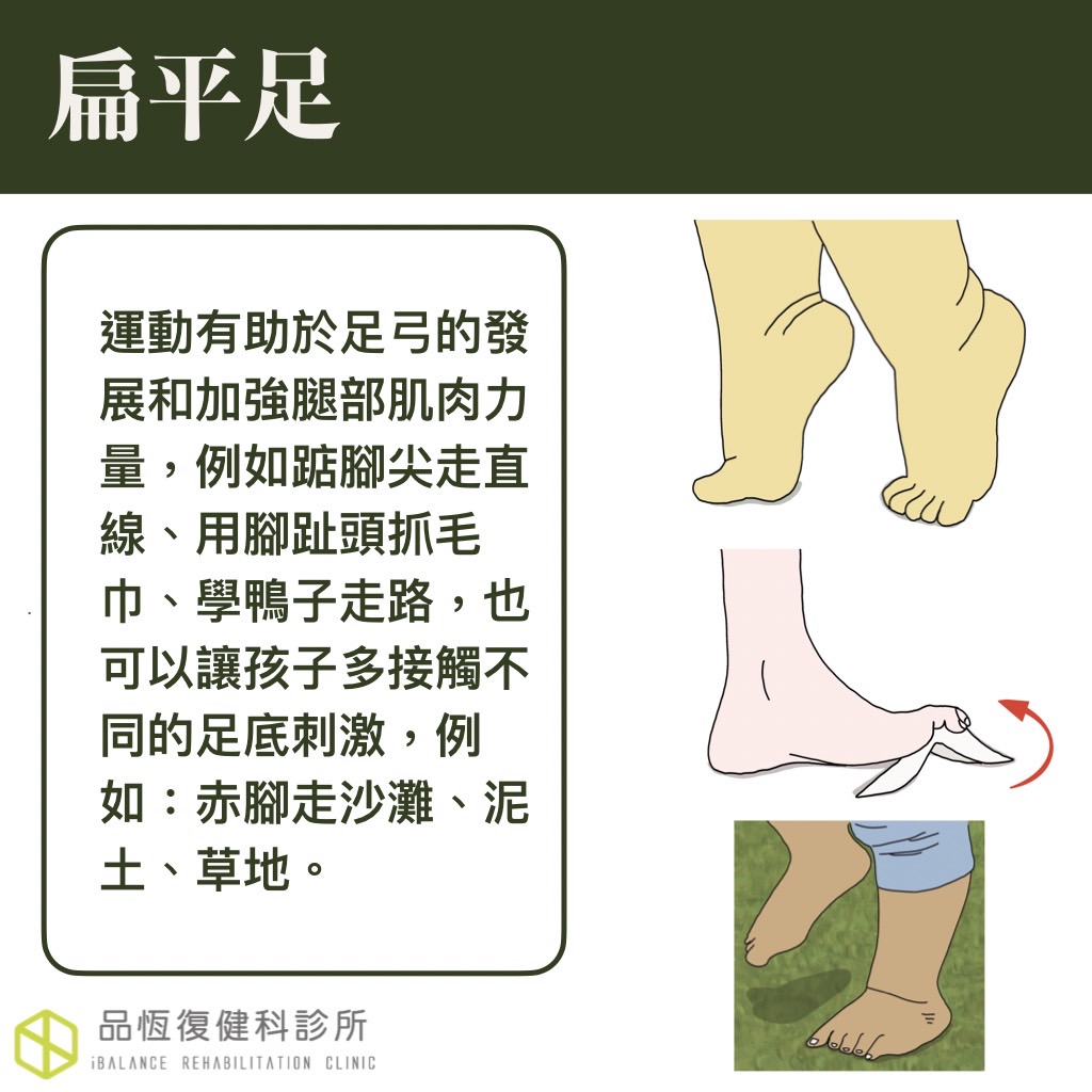 扁平足 扁平足