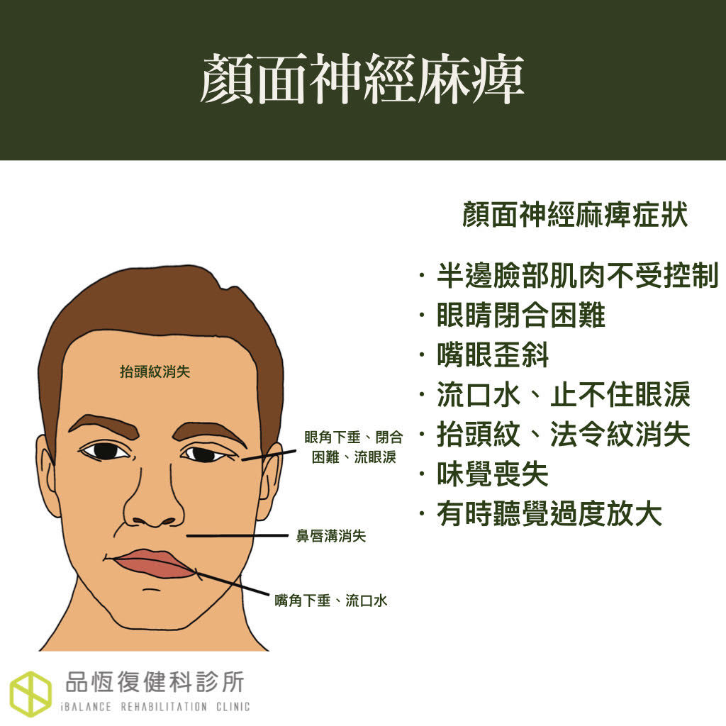 顏面神經麻痺 顏面神經麻痺