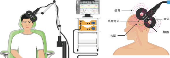 rTMS重複經顱磁刺激治療 rTMS重複經顱磁刺激治療